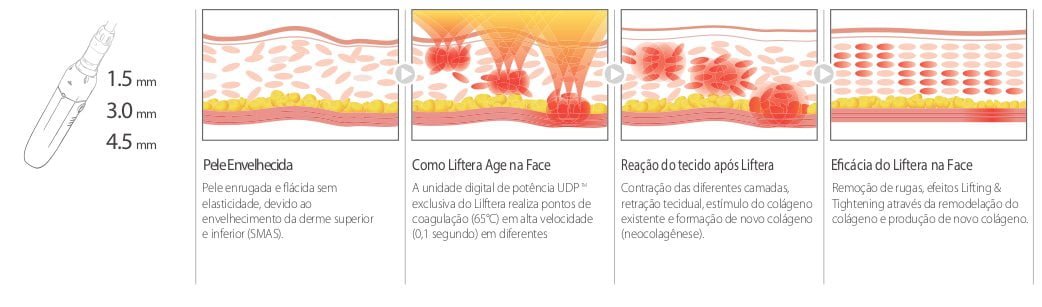 liftera-v-facial
