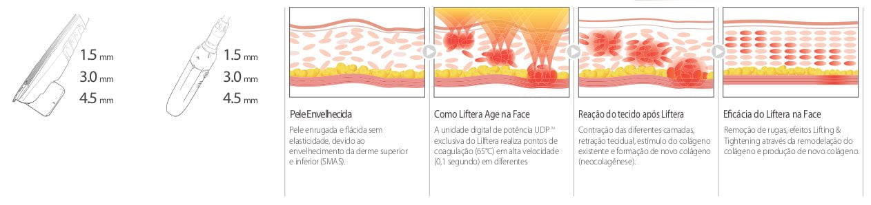 pele-liftera-a-